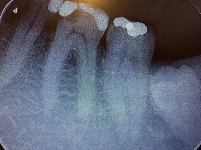 https://www.lisadentista.it/wp-content/uploads/2023/11/endodonzia-2-640x480.jpg