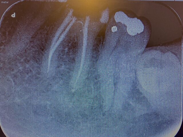 https://www.lisadentista.it/wp-content/uploads/2023/11/endodonzia-3-640x480.jpg